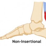 non-insertional achilles tendonitis