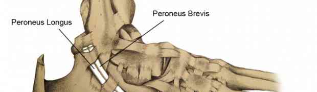 Peroneal Tendonitis