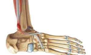 Types Of Foot Tendonitis