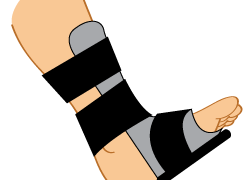 Night Splints for Plantar Fasciitis