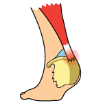 Insertional vs. Non-Insertional Achilles Tendonitis